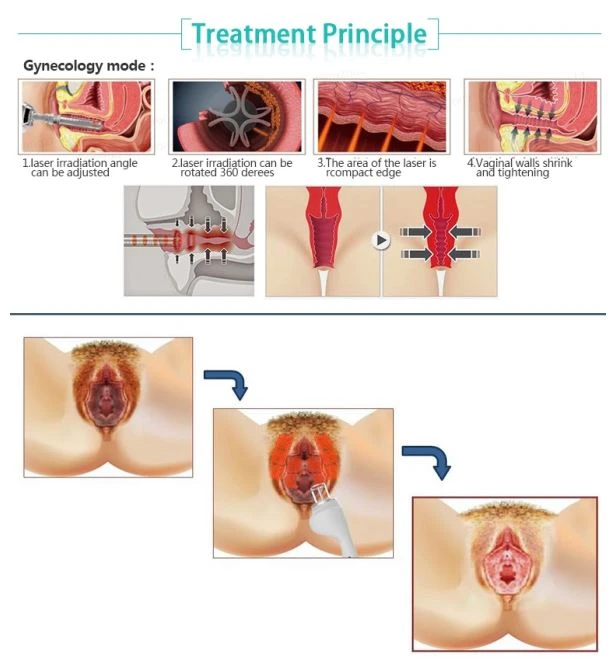 laser co2 fractional for skin