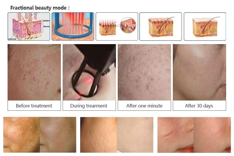 laser stretch mark removal machine